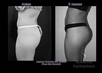 Antes y después de Implantes glúteos