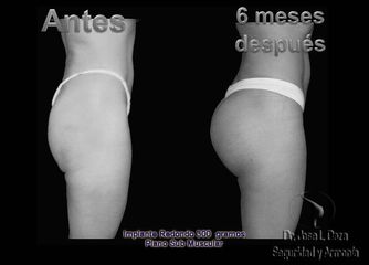Antes y después de Implantes glúteos