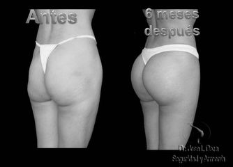 Implantes glúteos