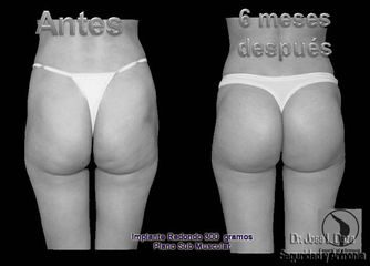 Antes y después de Implantes glúteos