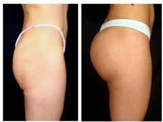 Antes y después de Gluteoplastia