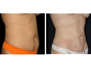 Antes y después de Lipoescultura