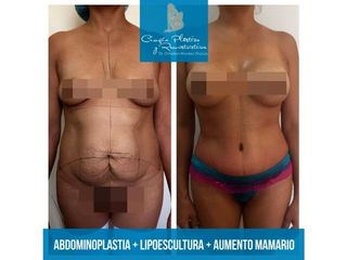 Aumento de mamas, liposucción y abdominoplastia