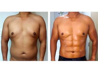 Antes y después de liposucción VASER.