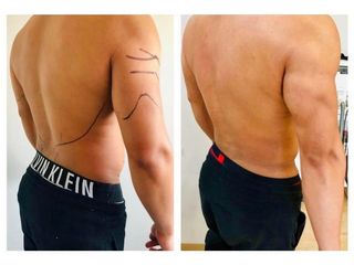 Antes y después de Lipoescultura