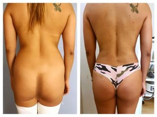 Antes y después de Lipoescultura