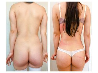 Antes y después de  Liposucción