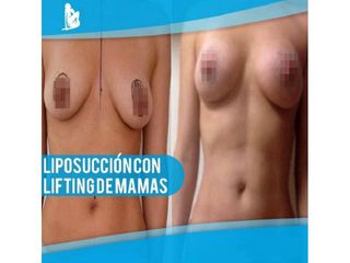 Antes y después de Liposucción - Dr. Christian Augusto Morales Orozco
