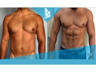 Liposucción - Dr. Christian Augusto Morales Orozco