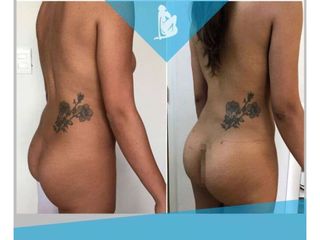 Gluteoplastia - Dr. Christian Augusto Morales Orozco