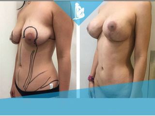 Mommy makeover - Dr. Christian Augusto Morales Orozco