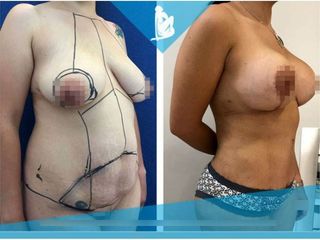 Lipoescultura - Dr. Christian Augusto Morales Orozco