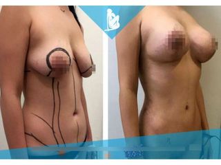 Lipoescultura - Dr. Christian Augusto Morales Orozco