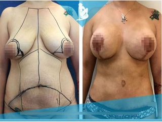 Lipoescultura - Dr. Christian Augusto Morales Orozco
