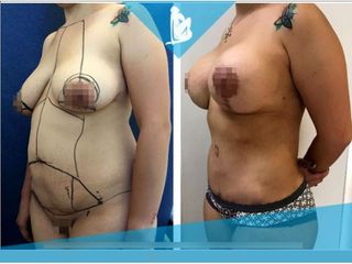Lipoescultura - Dr. Christian Augusto Morales Orozco