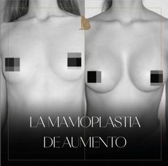 Aumento de busto - Dr. Christian Augusto Morales Orozco