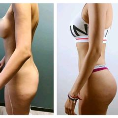 Gluteoplastia - Dr. Christian Augusto Morales Orozco