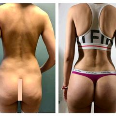 Gluteoplastia - Dr. Christian Augusto Morales Orozco
