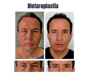 Blefaroplastia - Dr. Christian Augusto Morales Orozco