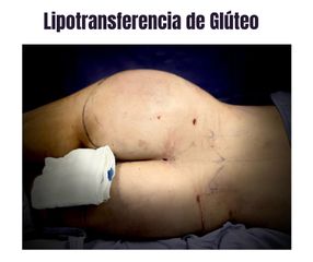 Lipotransferencia de Glúteo - Dr. Christian Augusto Morales Orozco