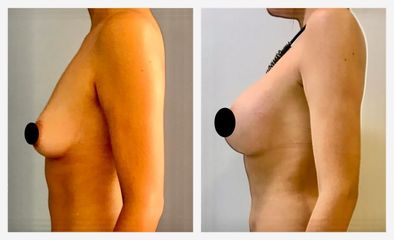 Aumento de busto - Dr. Christian Augusto Morales Orozco