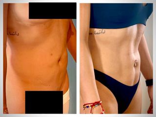 Liposucción - Dr. Christian Augusto Morales Orozco