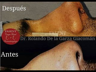 Rinoplastia - Fasent. Dr Rolando de la Garza Giacomán