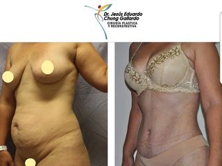 Antes y después de Abdominoplastia