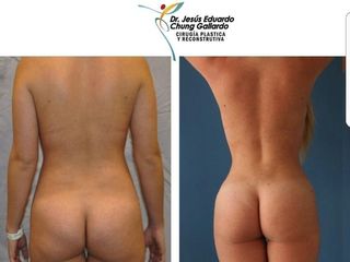 Antes y después de Lipoescultura