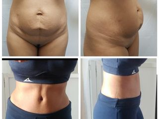 Antes y después de Abdominoplastia 