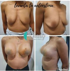 Antes y despues de mastopexia - Dr. Jesus Eduardo Chung Gallardo