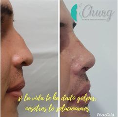 Antes y despues de Rinoplastía - Dr. Jesus Eduardo Chung Gallardo