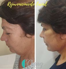 Antes y despues de rejuvenecimiento facial - Dr. Jesus Eduardo Chung Gallardo