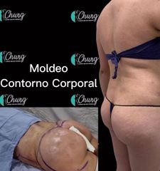 Antes y despues gluteoplastia - Dr. Jesus Eduardo Chung Gallardo