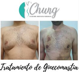 Antes y despues ginecomastia - Dr. Jesus Eduardo Chung Gallardo