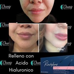 Antes y despues de labios - Dr. Jesus Eduardo Chung Gallardo