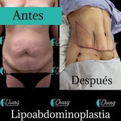 Antes y despues de Abdominoplastia lipoabdominoplastia - Dr. Jesus Eduardo Chung Gallardo