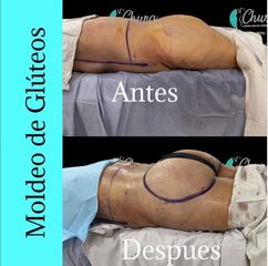 Antes y despues de gluteoplastia - Dr. Jesus Eduardo Chung Gallardo