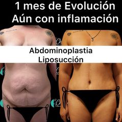 Antes y despues abdomino y liposuccion - Dr. Jesus Eduardo Chung Gallardo