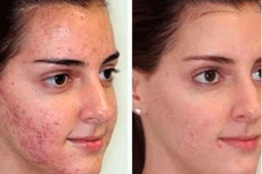 Microdermoabrasión antes y después - 500915