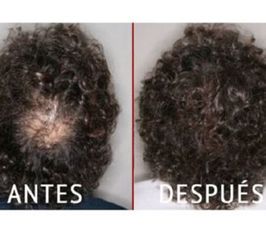 Antes y despuúes de tratamiento de alopecia