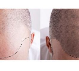 Antes y despuúes de tratamiento de alopecia