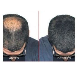 Antes y después de trasplante de cabello