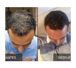 Antes y después de trasplante de cabello