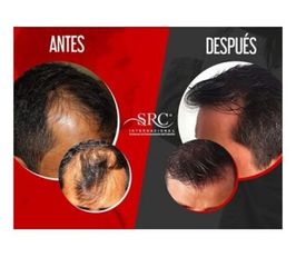 Antes y después de trasplante de cabello 