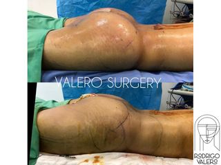 Gluteoplastia - Dr. Rodrigo Valero Jarillo