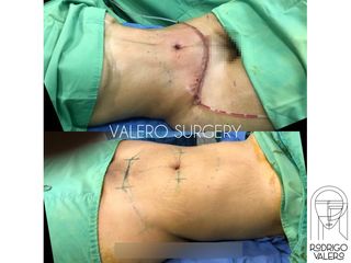 Liposucción - Dr. Rodrigo Valero Jarillo