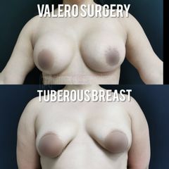 Mastopexia - Dr. Rodrigo Valero Jarillo