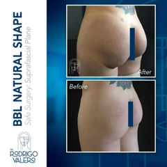 Gluteoplastia - Dr. Rodrigo Valero Jarillo