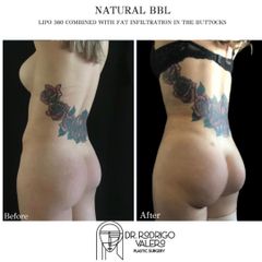 Gluteoplastia - Dr. Rodrigo Valero Jarillo